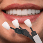 How Dentists Blend New Veneers With Untreated Natural Teeth