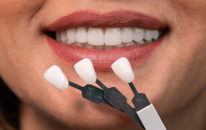 How Dentists Blend New Veneers With Untreated Natural Teeth